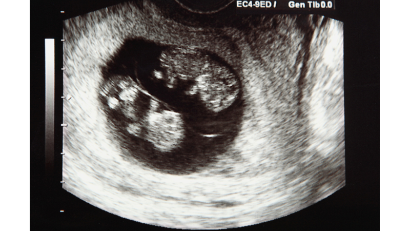 İkiz çocuk Sahibi Olmak Genetik mi Etnik mi?